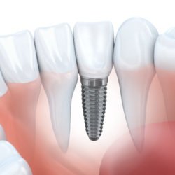 same day dental implants